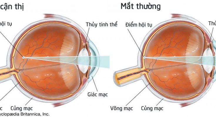 Sự khác nhau ɡiữa cận thị, loạn thị và viễn thị 1 can thi