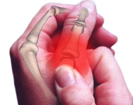 Phân biệt viêm khớp và ɡút 1 2321 benh gut