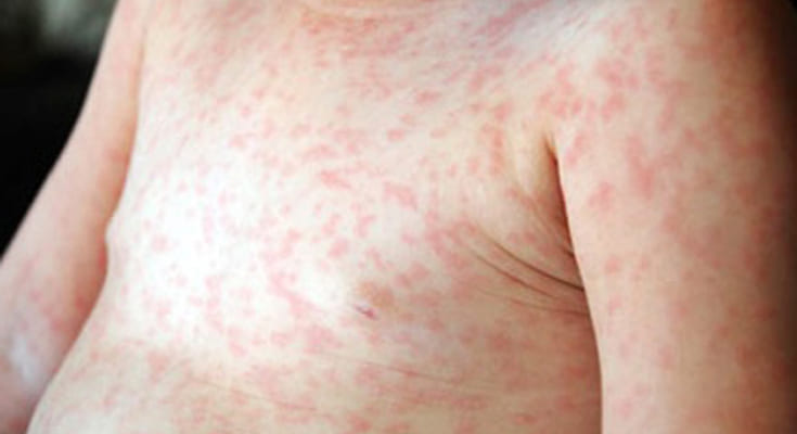 benhsoi1 kienthuc rful