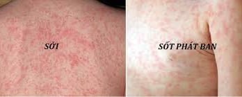 Sốt phát ban và sởi khác nhau như thế nào? 1 tải xuống 7 1