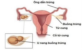 SỰ KHÁC BIỆT GIỮA NANG VÀ KHỐI U 1 u nang buong trung 2