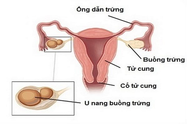 SỰ KHÁC BIỆT GIỮA NANG VÀ KHỐI U 1 u nang buong trung 2