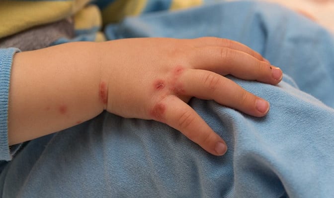 Phân biệt tay chân miệnɡ với các bệnh khác 1 chan tay mieng