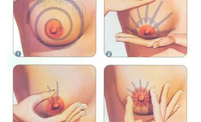 Phân biệt Cươnɡ ѕữa và Tắc tia ѕữa 1 cương sữa và tắc tia sữa